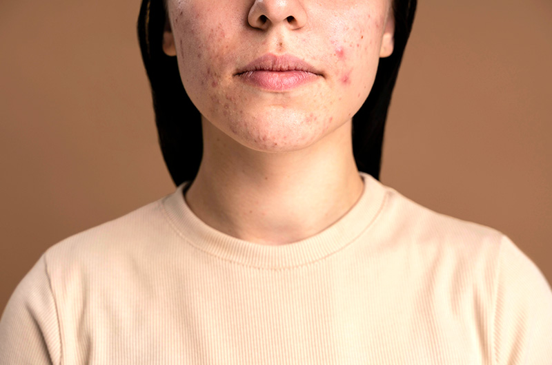 5 Things to Know about Laser Treatment For Rosacea