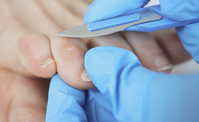 Ingrown nails & corns