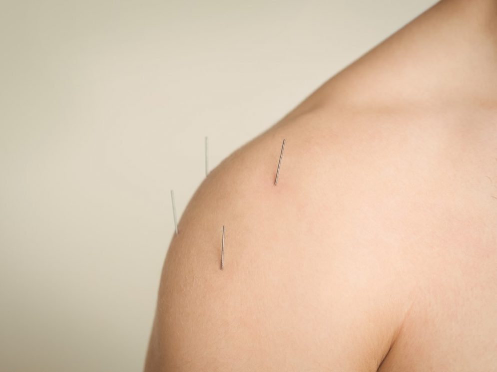 Dry needling